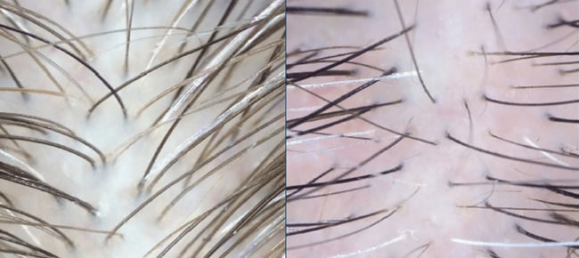 190909-thinning-hair-follicles